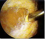 Arthroscopic Electrothermal Lateral Release