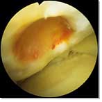 Deep osteochondral defect