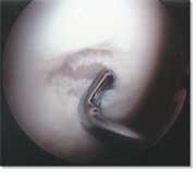 Small Chondral Defect of the Medial Femoral Condyle