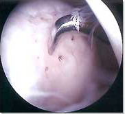 Arthroscopic Microfracture of the Medial Femoral Condyle