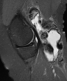 Large Baker's Cyst with PVNS