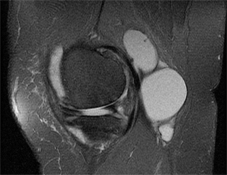 Septated Baker's Cyst