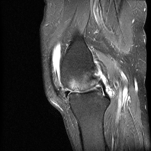 MFC Bone Marrow Oedema and Subchondral Cyst