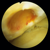 Osteochondral Defect of the Medial Femoral Condyle