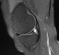 Torn Medial Meniscus. CKC MRI