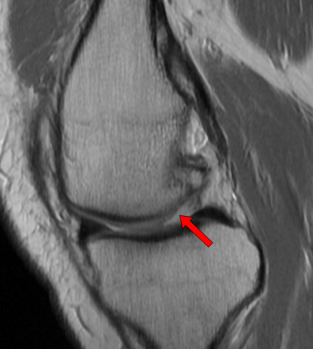 Subtle MFC chondral defect