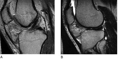 MRI - Enlarged Fat Pad