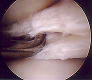 Lateral Meniscal Cyst and Horizontal Tear