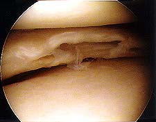 Medial Meniscal Cyst