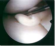 Flap Tear of the Medial Meniscus