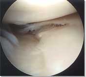 Radial Medial Meniscal Tear