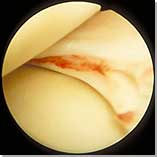 repairable Medial Meniscal Tear (Vascular Zone)