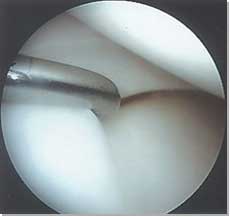 Normal Knee