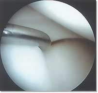 Normal Medial Meniscus