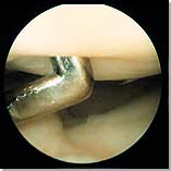 Soft Patella Cartilage (Chondromalatio Patellae)